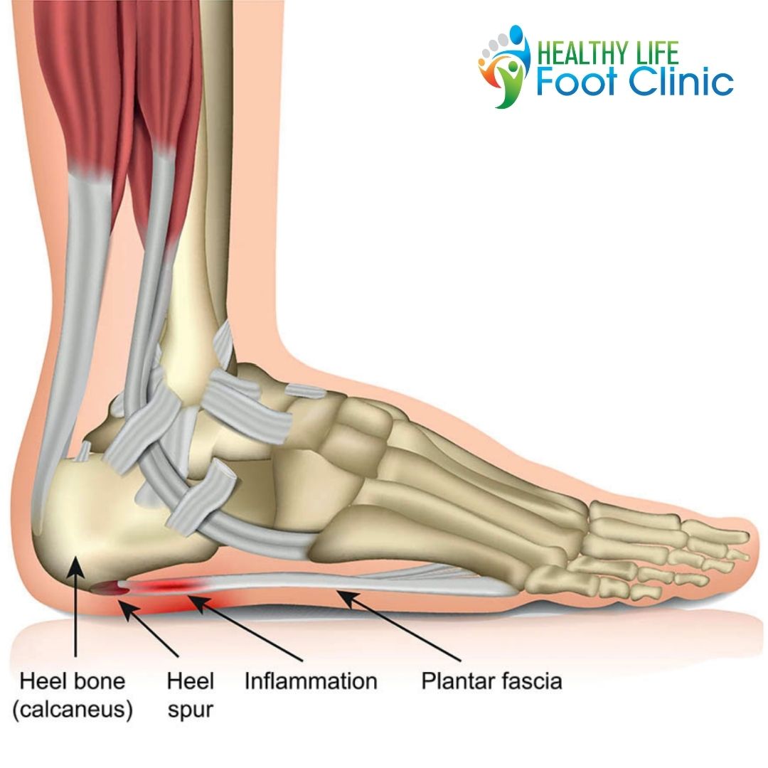 Plantar Fasciitis