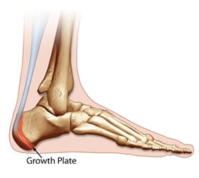 growth plate severs disease | Healthy Life Foot Clinic
