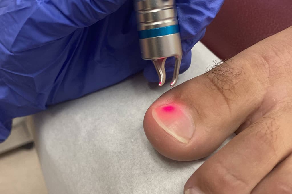 Nail Fungus - Advance Foot Clinic Podiatry