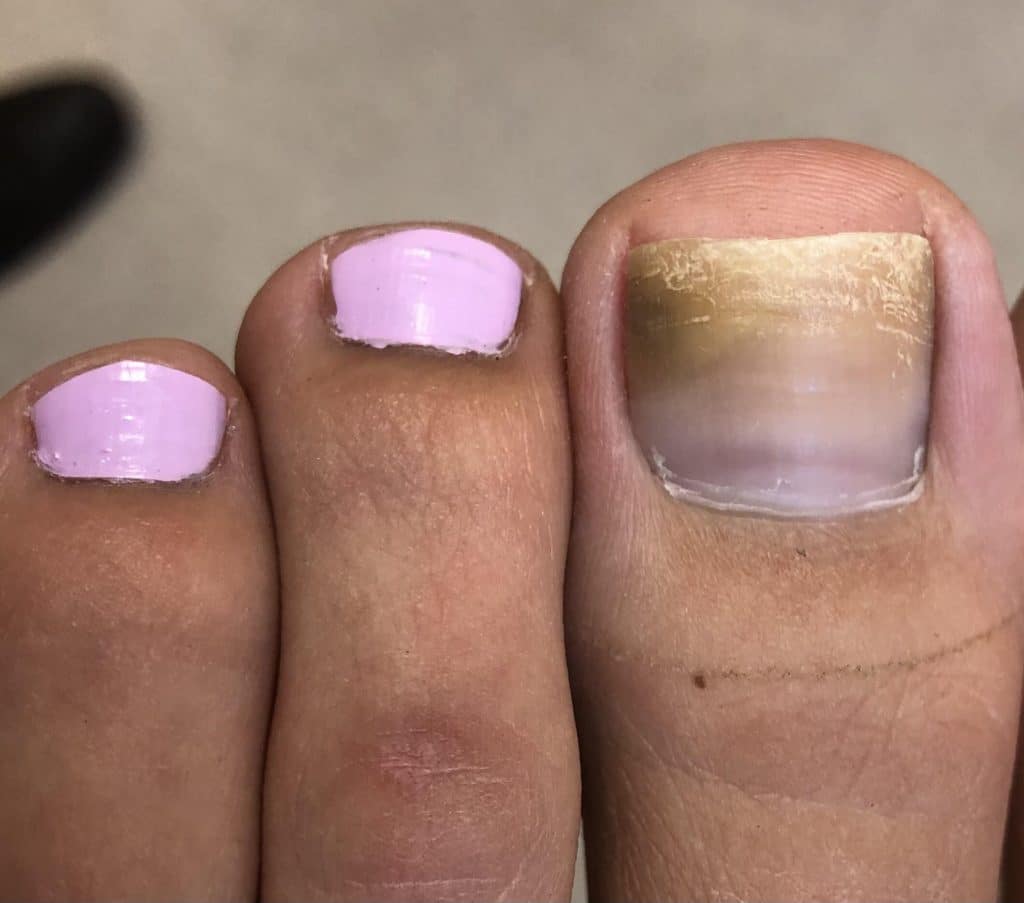 Top 6 Warning Signs of Toenail Fungus - The Foot Doc™