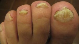 Patient with fungal toenails
