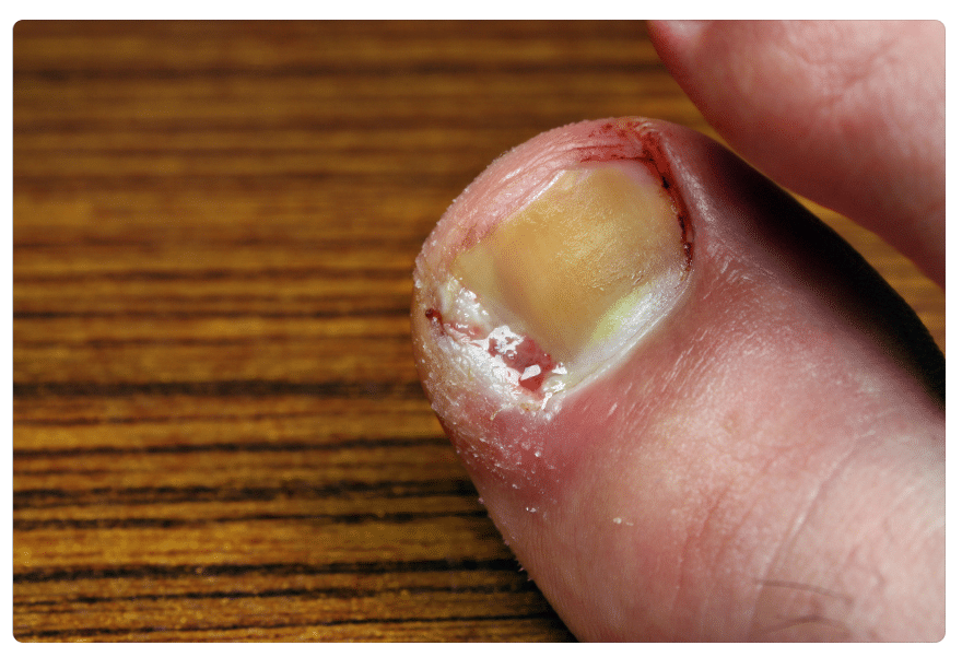 Toenail Fungus – Podiatry