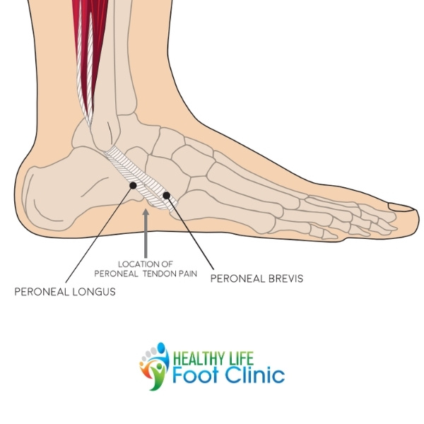 Peroneal Tendinopathy