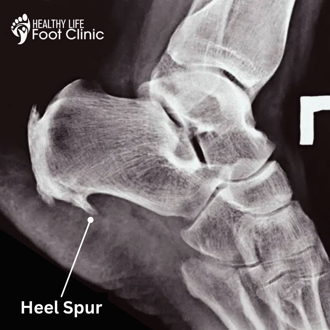 Heel Spur