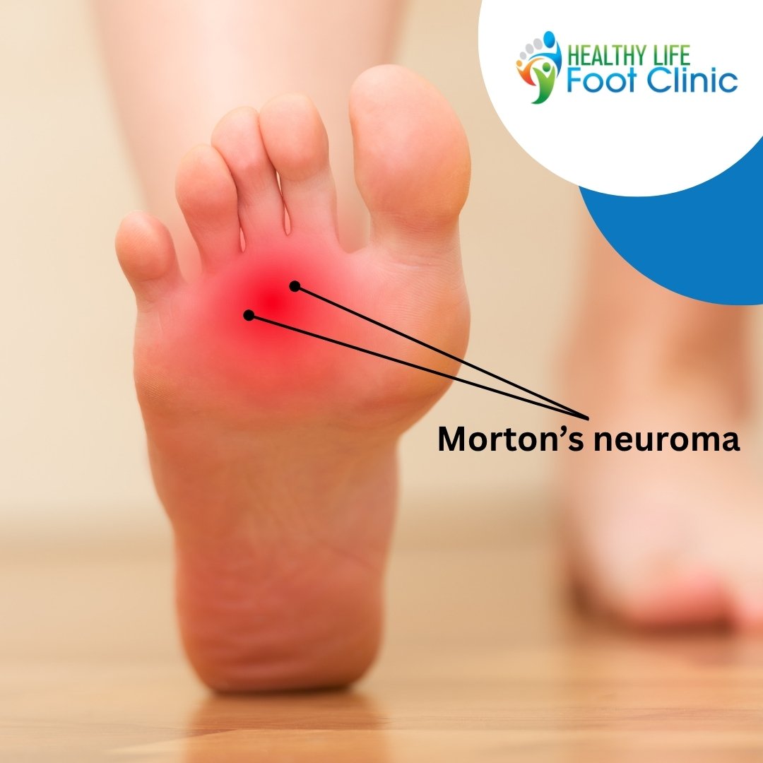 Morton’s neuroma