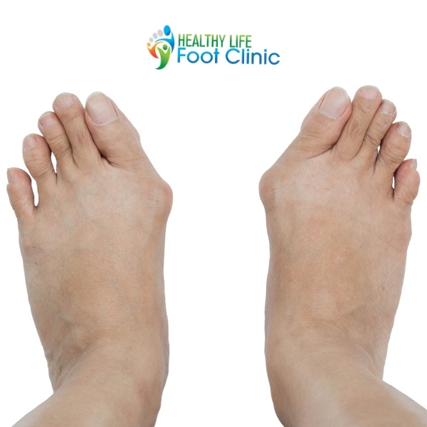 Patient with Bunions