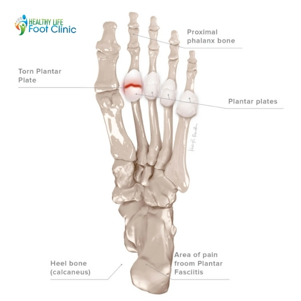 Plantar Plate