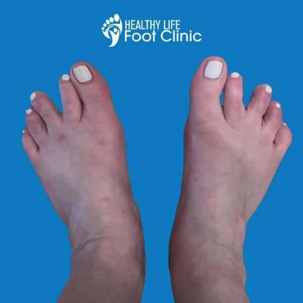 Patient with Plantar Plate Tear