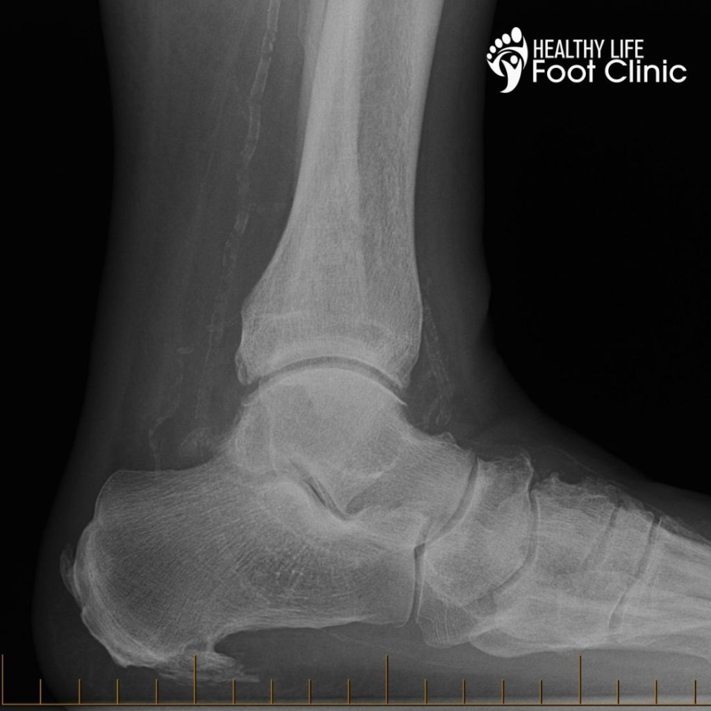 Xray image of Heel Spur