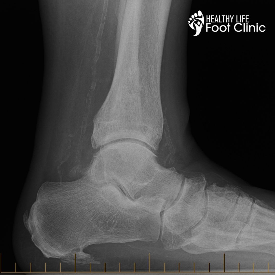 Xray image of Heel Spur