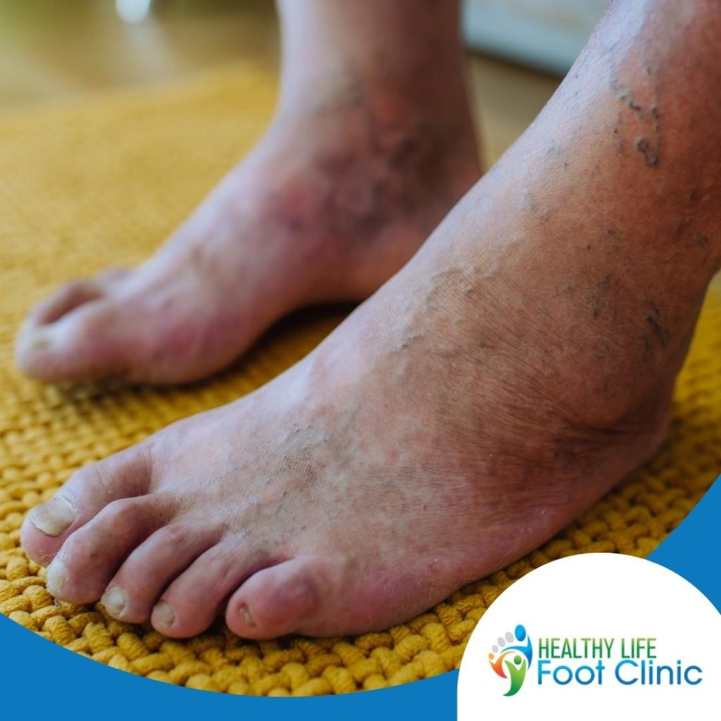 Diabetic Foot